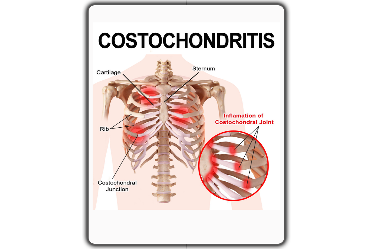 Introduction to Costochondral Joint Pain or Costochondritis