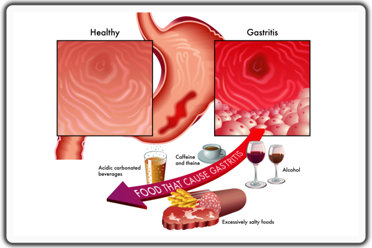 Acid Reflux and Gastroesophageal reflux disease (GERD) - acidic foods to avoid